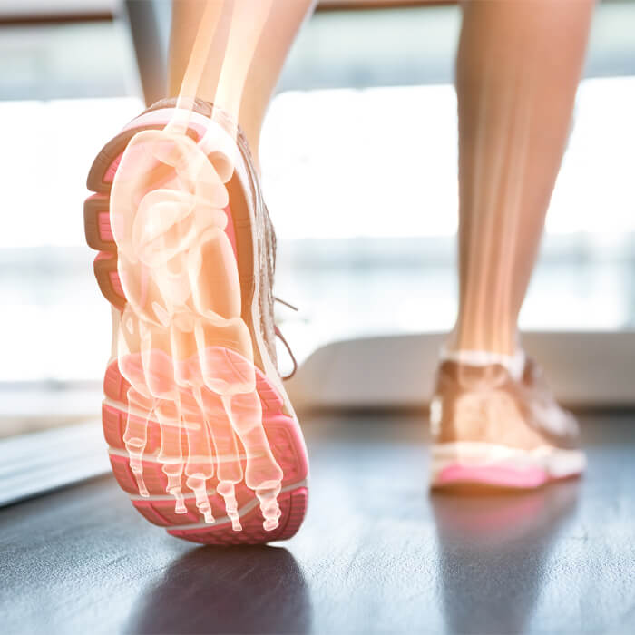 Person Walking on Treadmill with X-ray of Bones in Foot